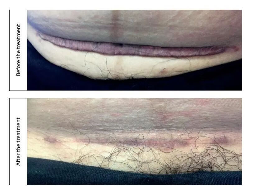 剖腹产的疤痕是什么样子的(剖腹产肚子疤痕)