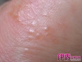 手上起小水泡是怎么回事(手上起小水泡图片)