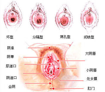 处女膜修复术(处修手术后会很难进入吗)