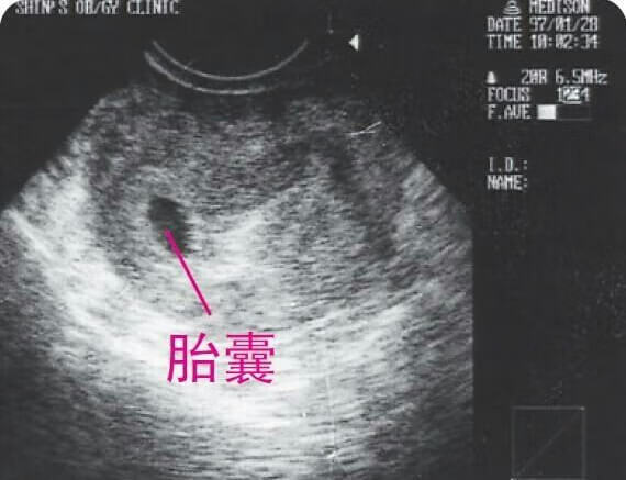 怀孕8个月胎儿b超图片(怀孕四个月b超图)