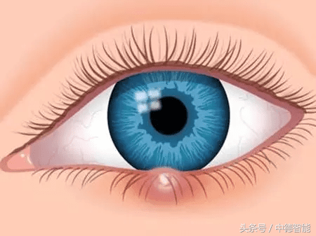 眼睛长针眼怎么办?(眼睛长针眼了怎么快速解决)