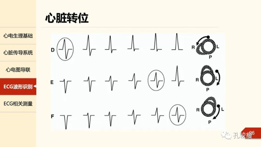 心电图导联位置示意图(心电图机导联位置图)