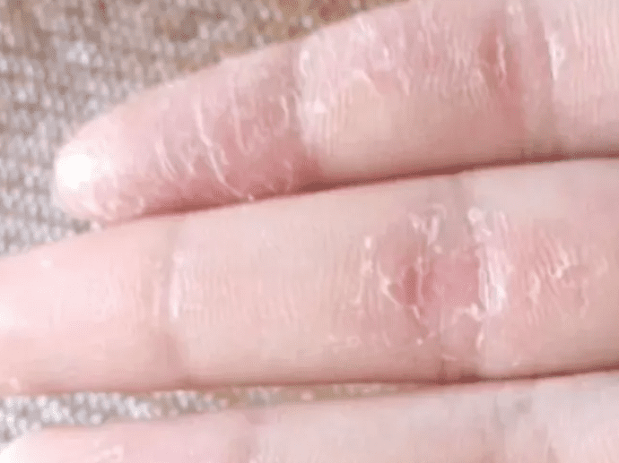 手指脱皮是什么原因造成的(手指脱皮是缺什么维生素)