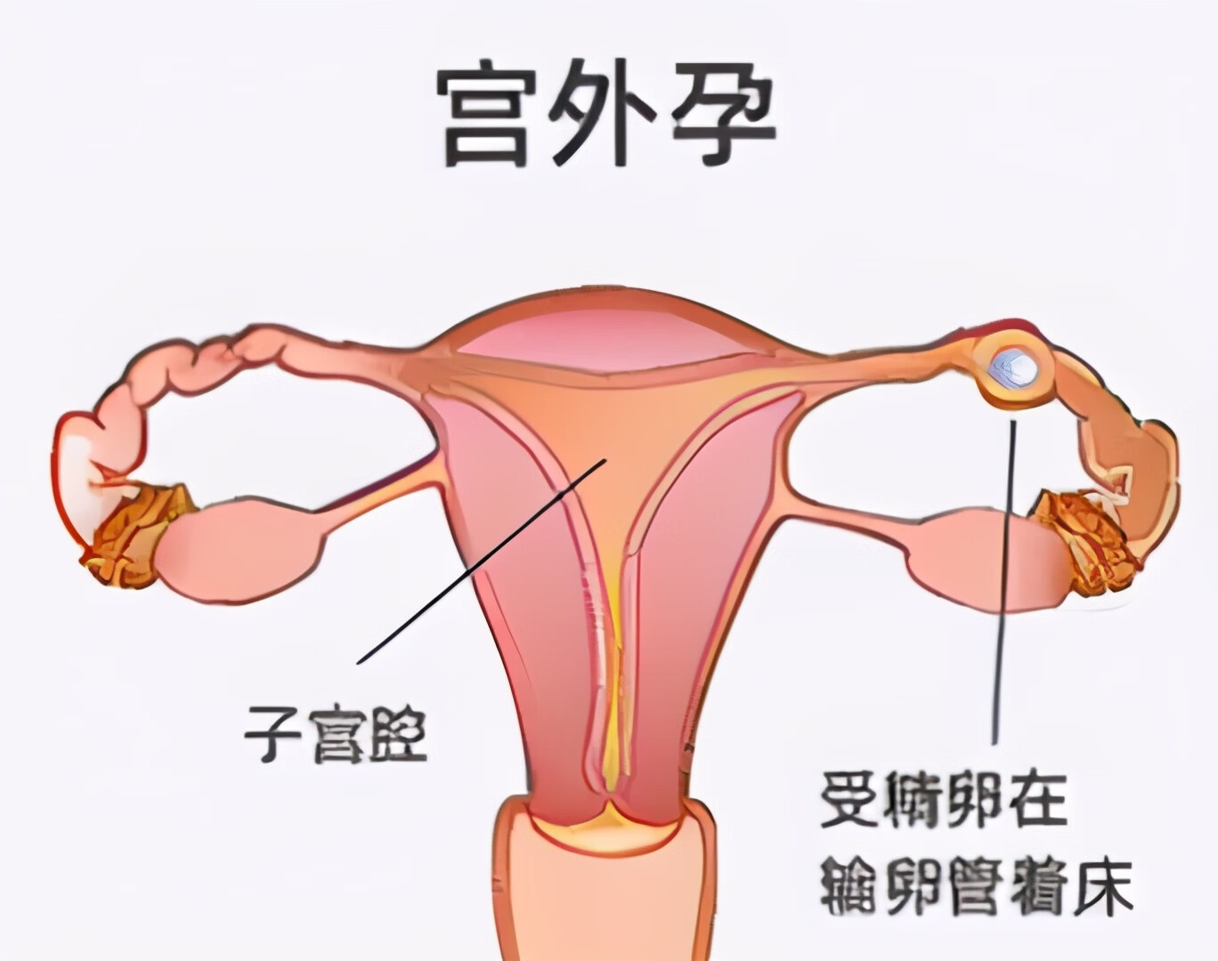 刚怀孕宫外孕有什么症状(什么是宫外孕症状早期)