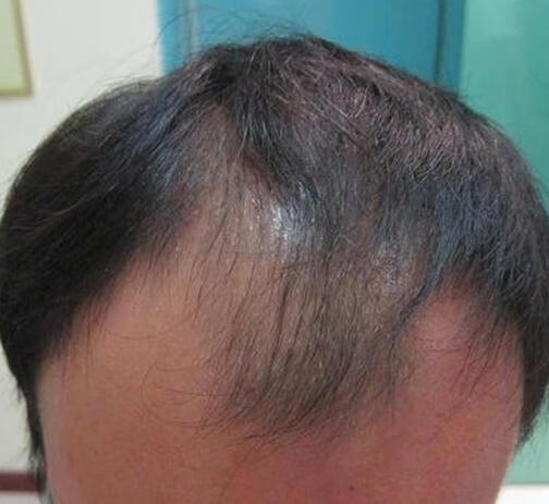 侧柏叶洗头的正确过程(侧柏叶如何洗头)