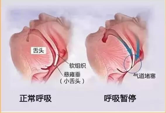 睡眠呼吸暂停综合征分类(睡眠呼吸暂停低通气综合征)
