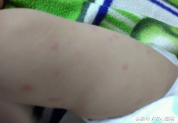 儿童寻麻疹会传染吗(荨麻疹会传染给家人吗)