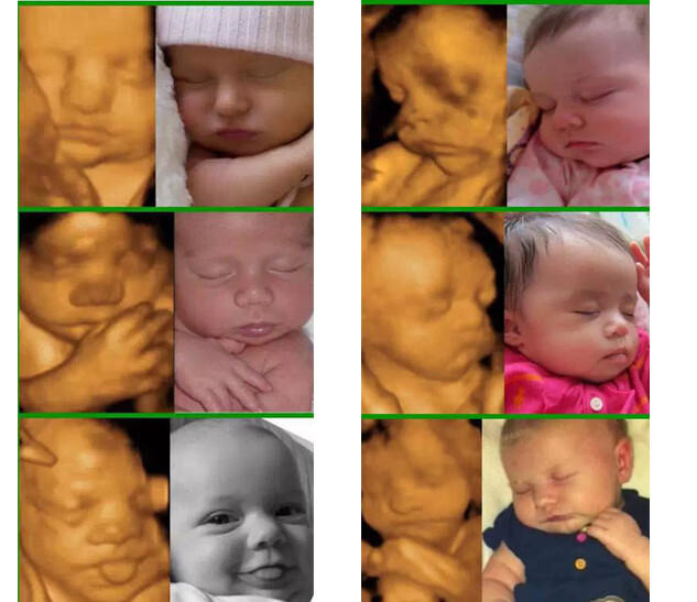 24周胎儿四维彩超图(孕期四维彩超图片)