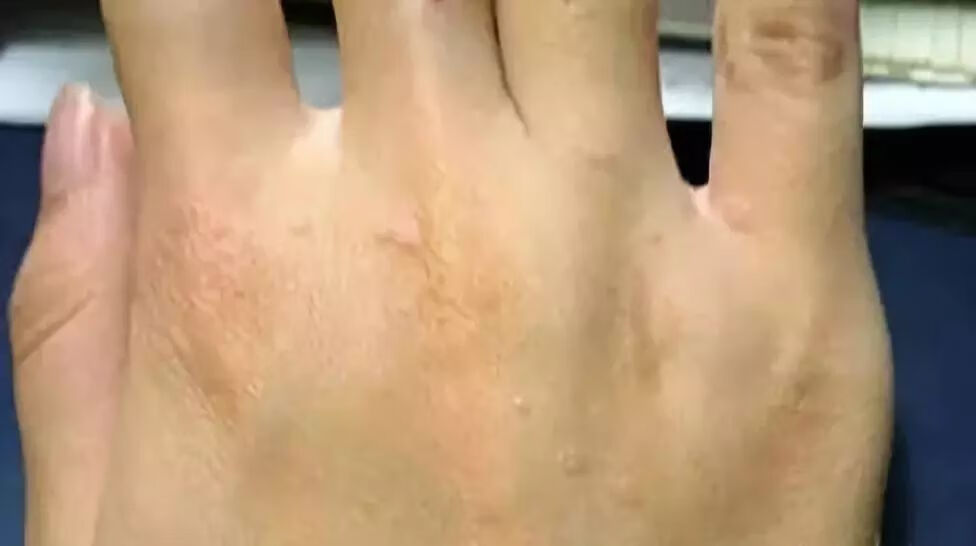 眼皮上长了个小疙瘩是怎么回事图片(上眼皮长出一个凸起的肉疙瘩)
