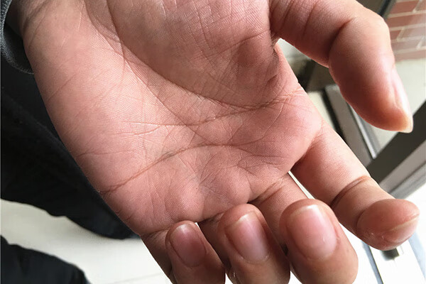手脚脱皮是怎么回事?怎么处理?(手上和脚上脱皮是怎么回事)