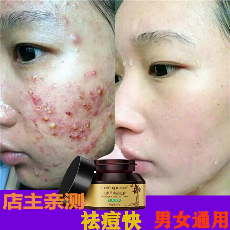 娅芝祛痘膏质量怎么样是大牌子吗