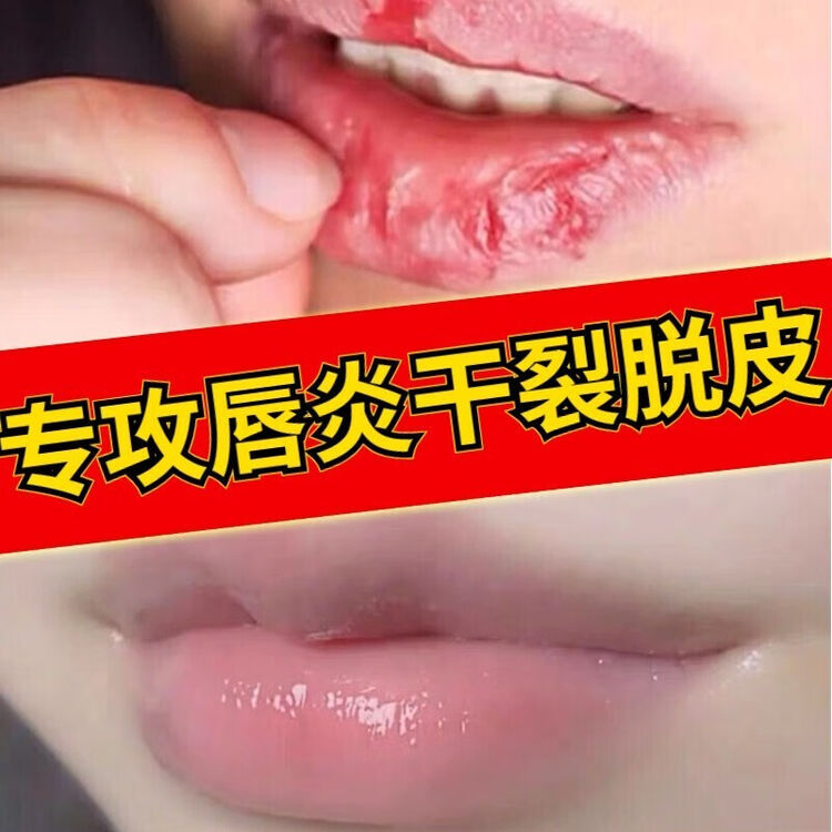 儿童可用 润唇膏唇炎唇膏嘴唇干裂脱皮嘴角开裂保湿唇油慢性口角炎护唇膏男女通用一盒装 图片价格品牌评论 京东