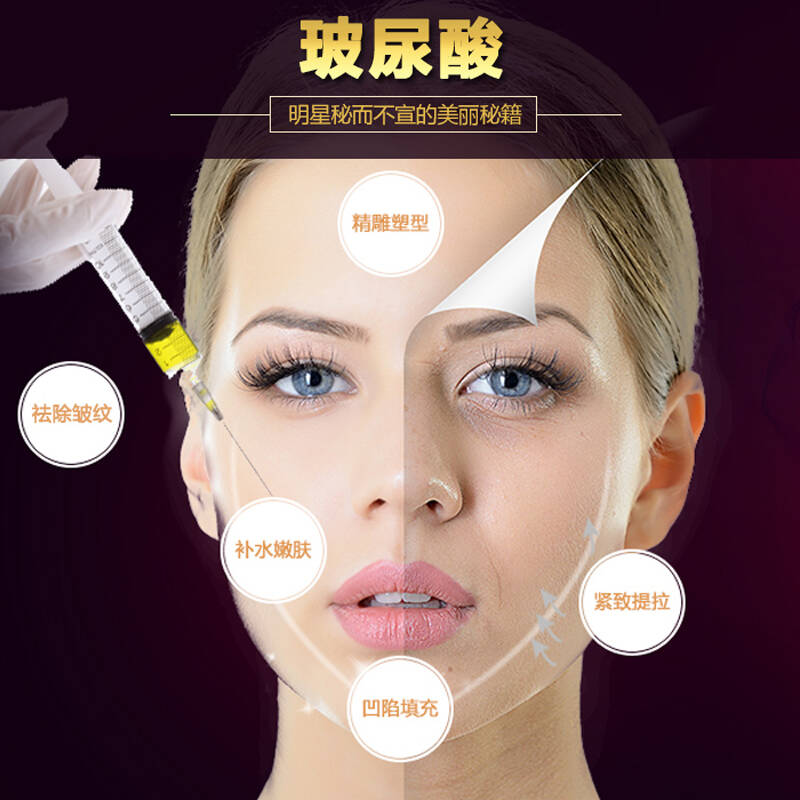 煤炭总医院国际医学美容整形中心 瑞蓝玻尿酸注射 玻尿酸注射