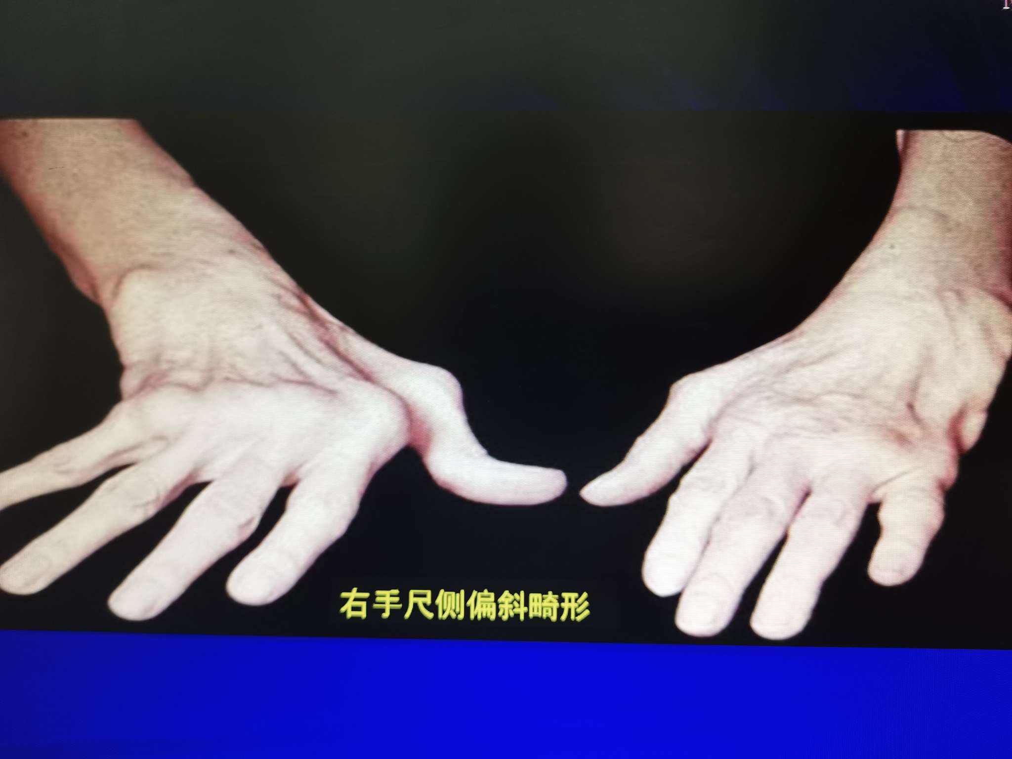 手指向尺侧偏斜图片