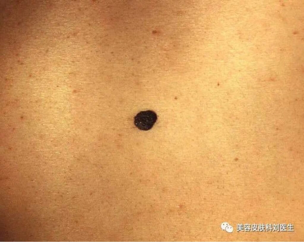 要学会识破黑色素瘤的“伪装”，4招教你辨别黑色素瘤和痣的区别_凤凰网