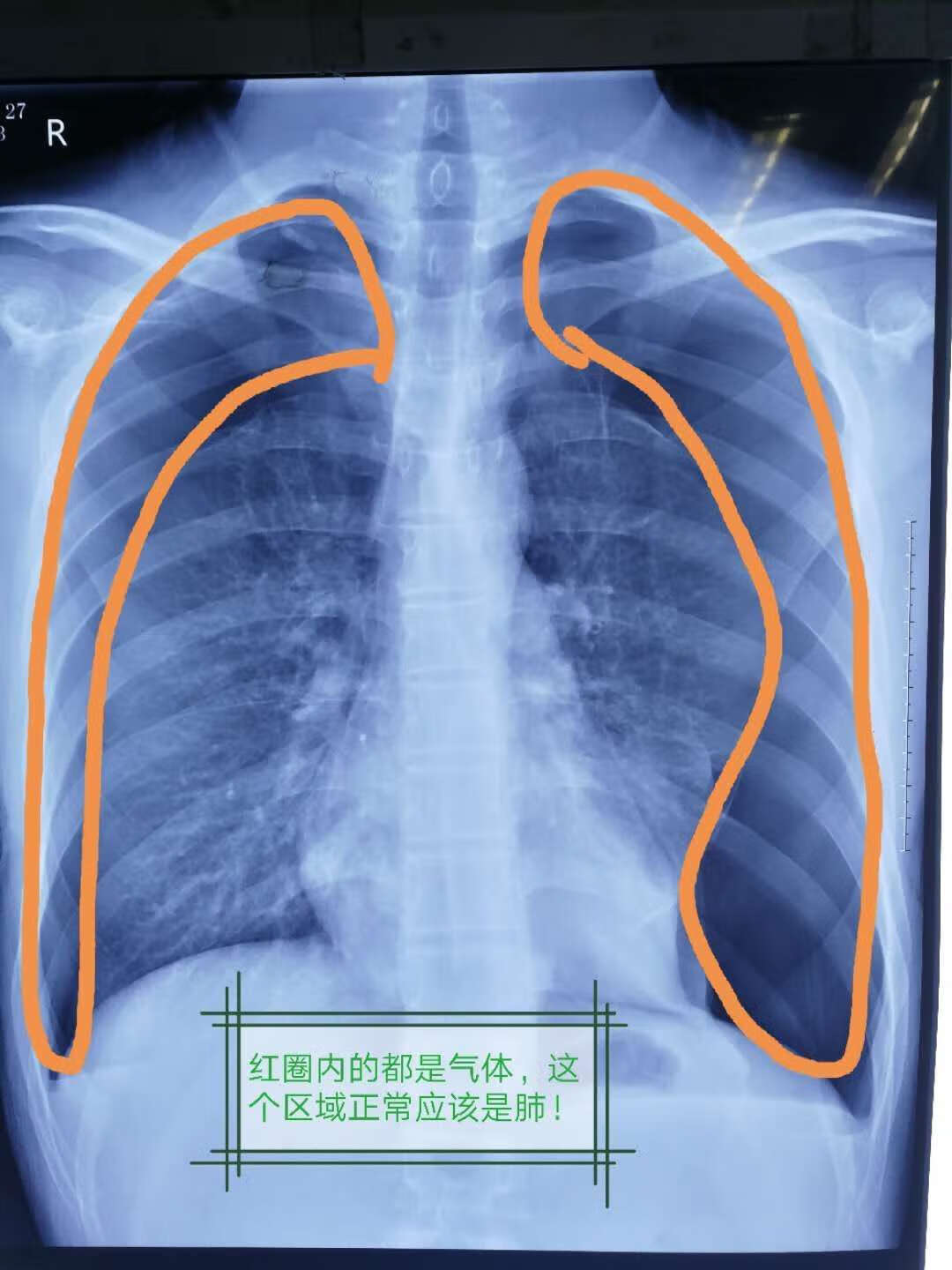 肺界限的体表投影-胸心外科解剖-医学