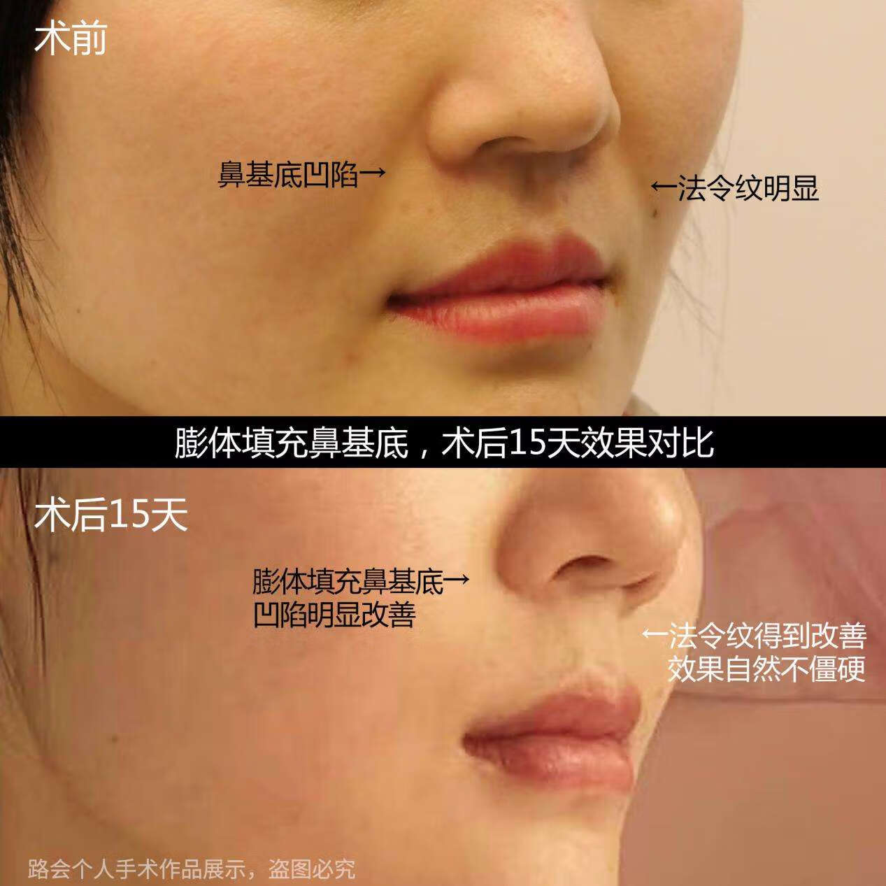 鼻修复案例 | 综合隆鼻修复案例合集（二）-蜜颜优惠