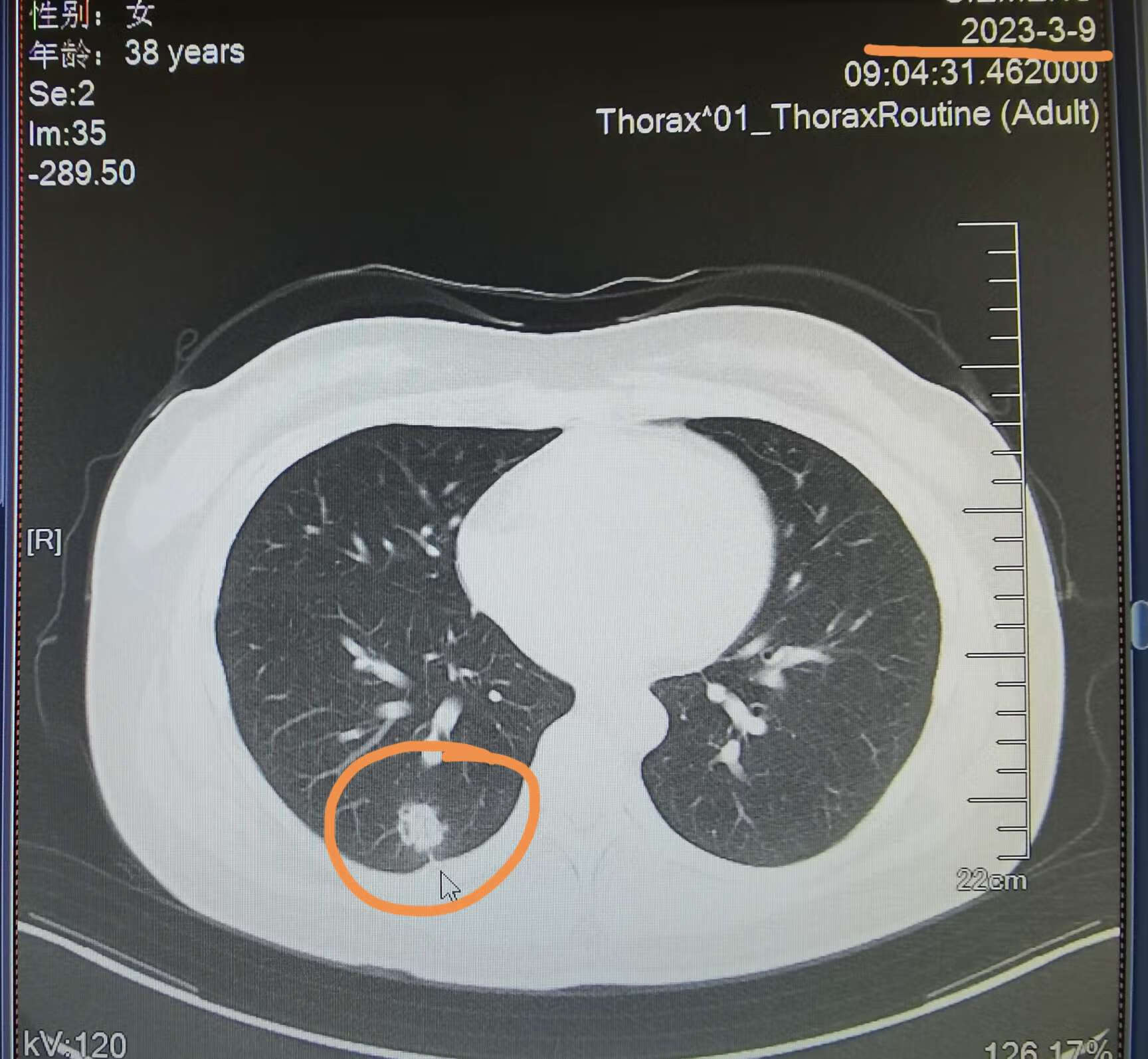 牵拉胸膜的肺结节消炎后复查明显消散了