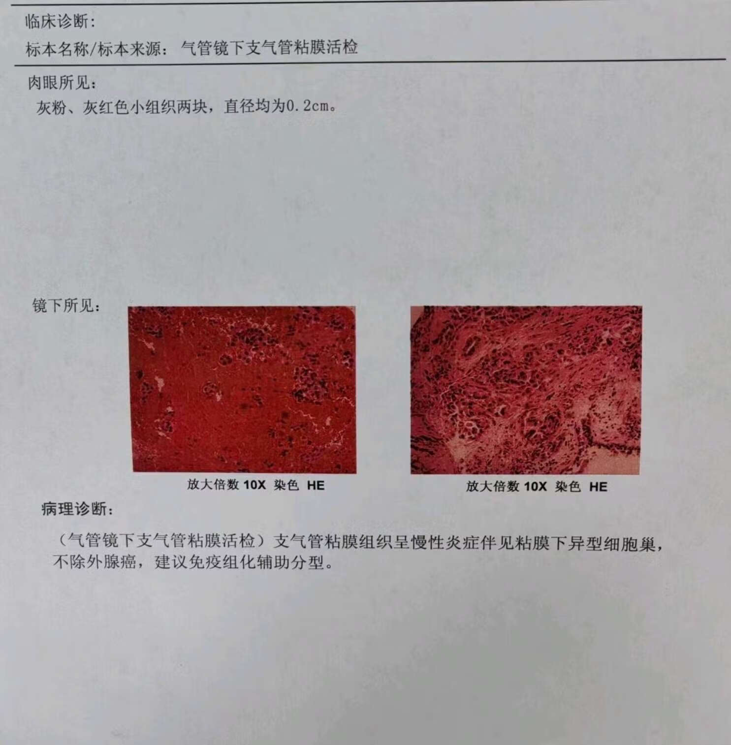 肺癌活检报告图片