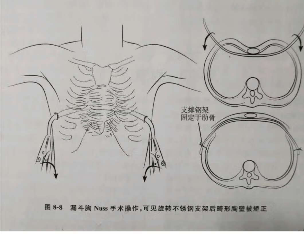 女童胸口凹陷似“漏斗”， 父母以为缺钙补了近十年_长江云 - 湖北网络广播电视台官方网站