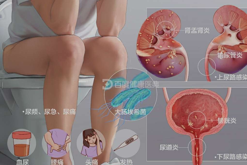 女性尿路感染为何常见？