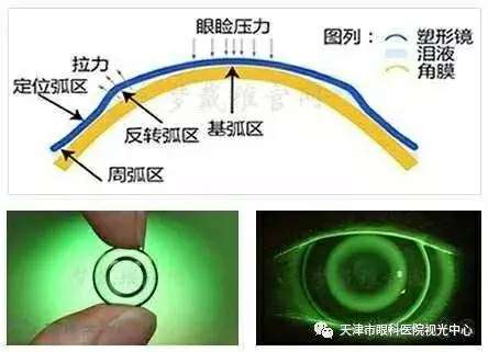 角膜塑形镜,俗称ok镜,是一种夜间睡觉配戴的硬性隐形眼镜,从而达到