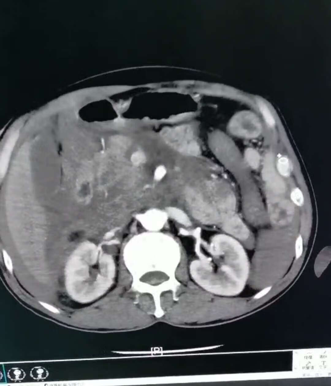 图14-15 大肠的淋巴引流-腹部外科临床解剖学-医学