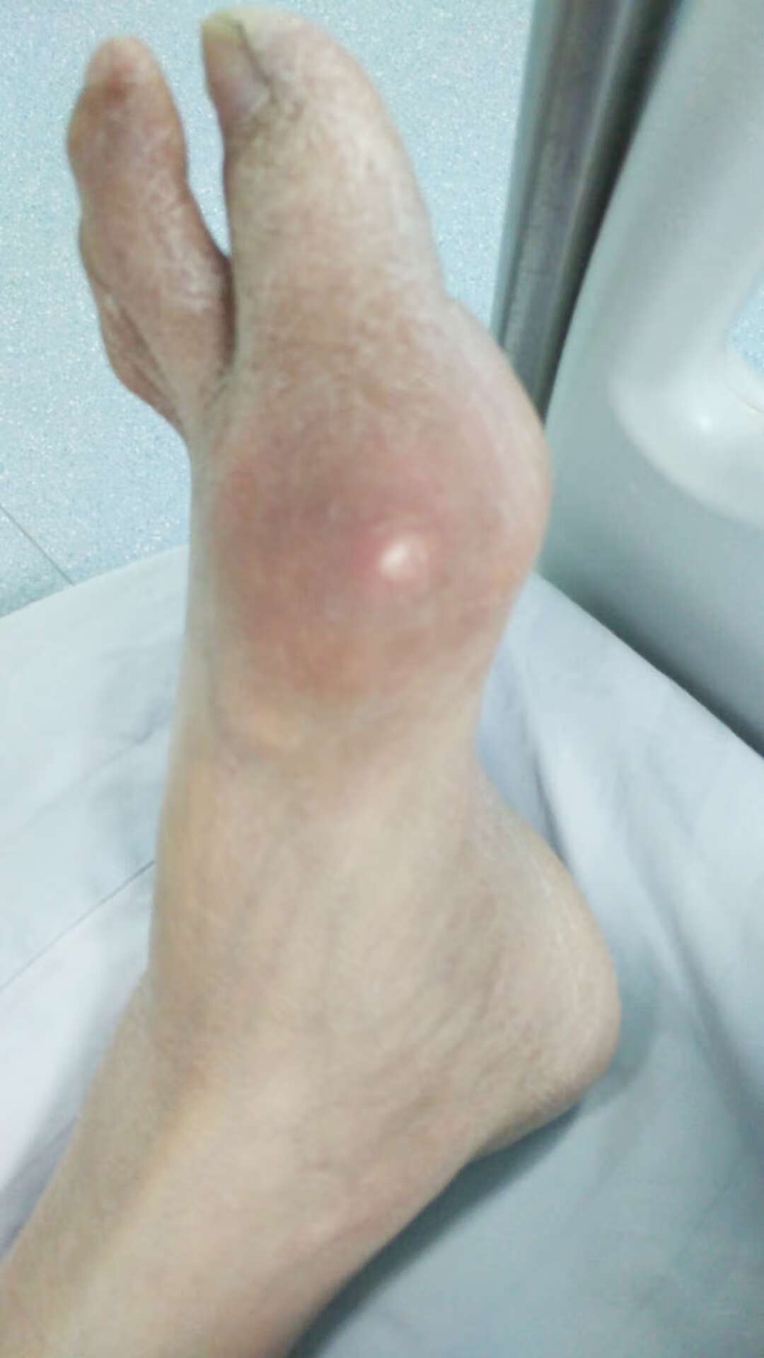 痛风性关节炎为什么有一半发生在第一跖趾关节