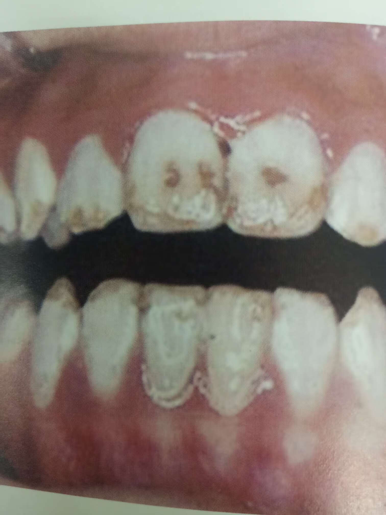 病例五：烤瓷冠修复氟斑牙 - 好大夫在线