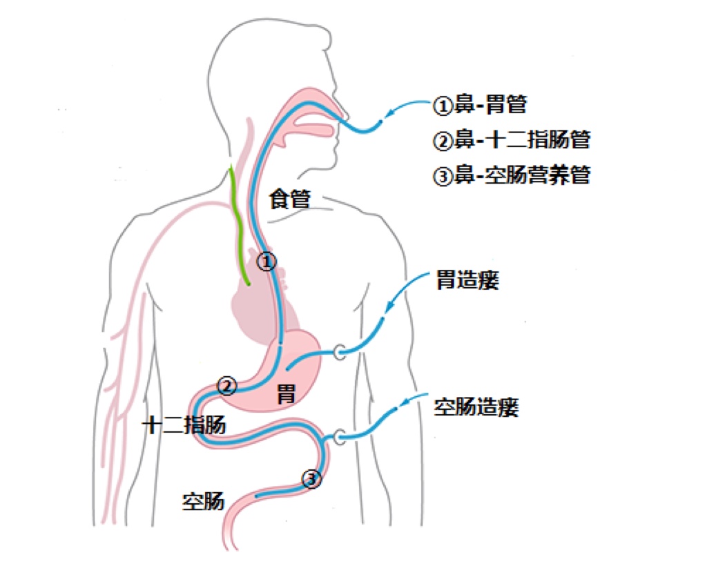 鼻肠管置入方法线路图图片