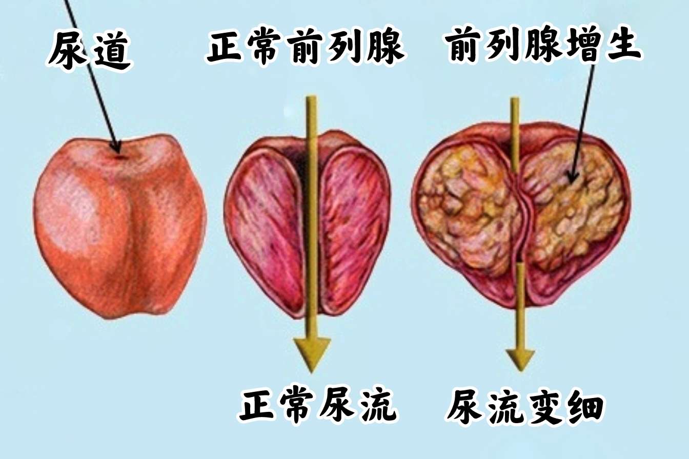 前列腺的“男言之隐”——《中国男性前列腺健康白皮书》解析 - 知乎