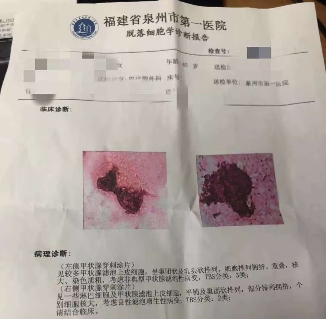 华容县人民医院超声科开展首例甲状腺细针穿刺术