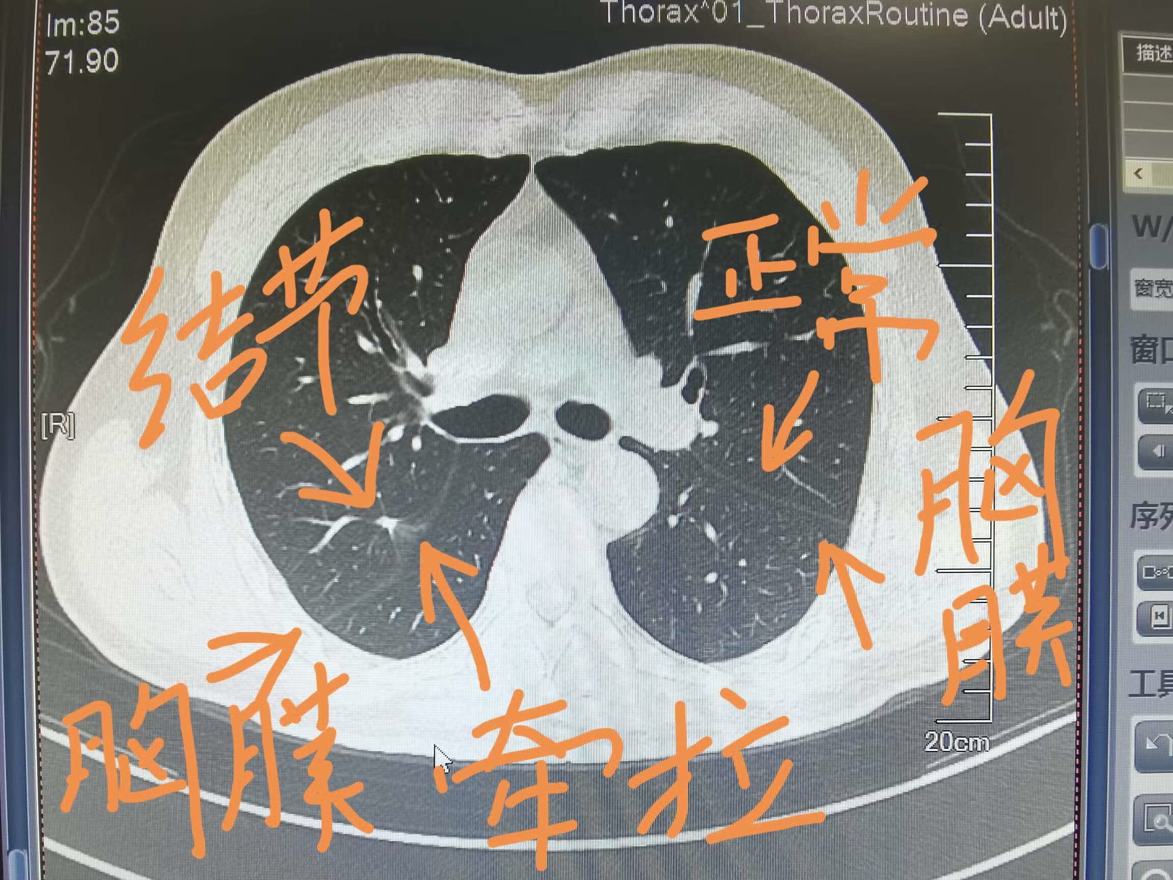 肺结节形态不规则牵拉叶间胸膜会是肺癌么?