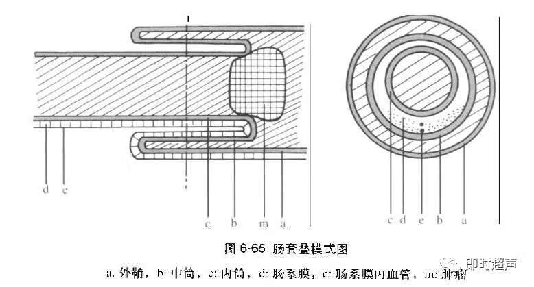 肠袢是什么图片