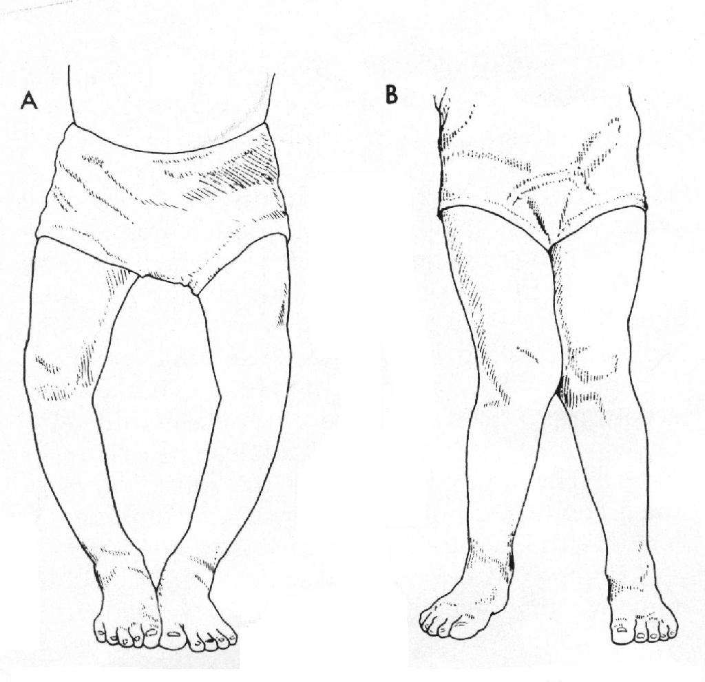 科案例｜儿童步态矫正展示－-O型腿 - 知乎