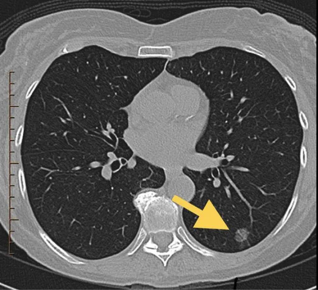 病例-83 肺非霍奇金淋巴瘤(弥漫性大B 细胞淋巴瘤)-少见病影像-医学