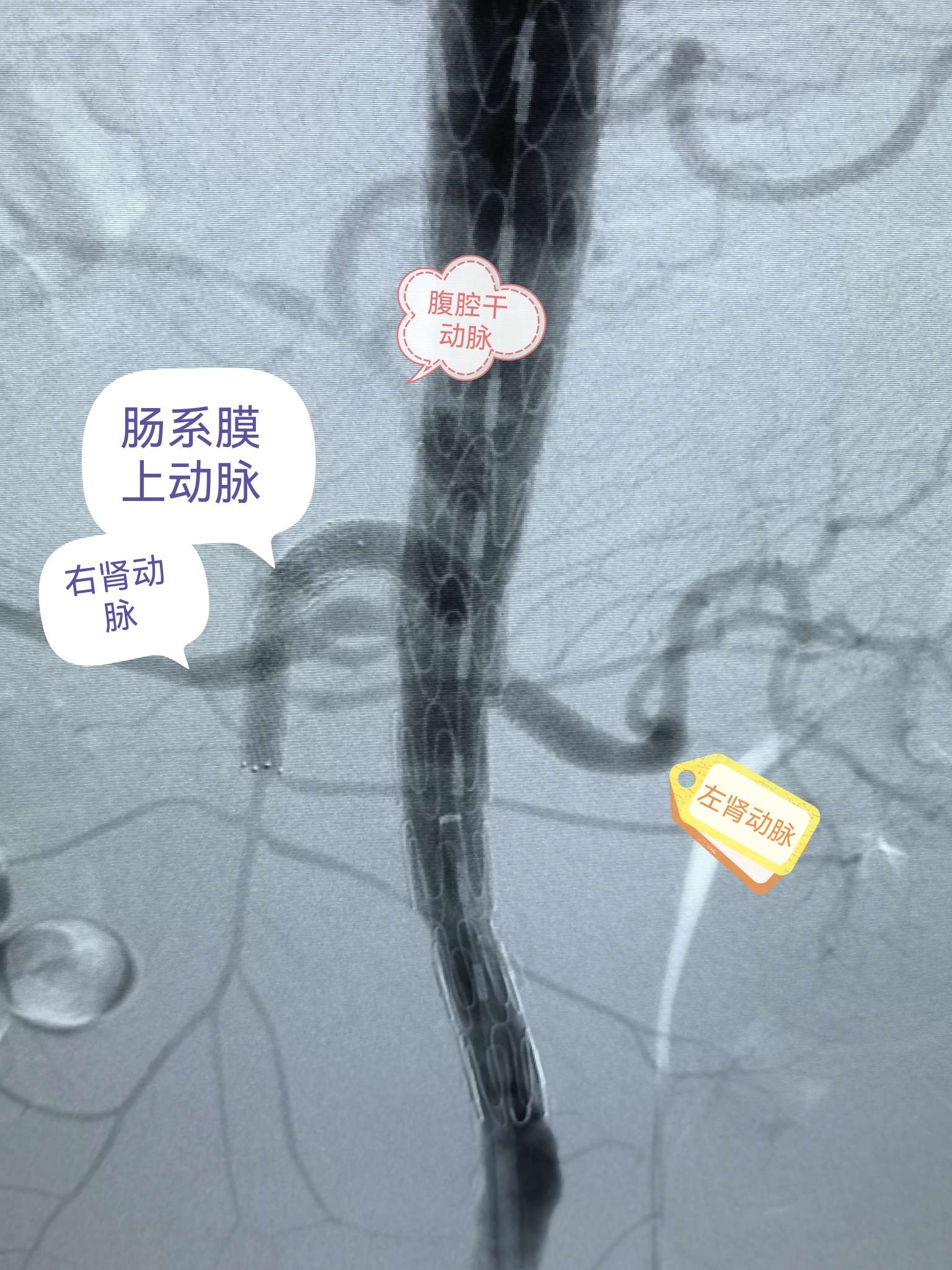 腹主动脉瘤开放手术__中国医疗