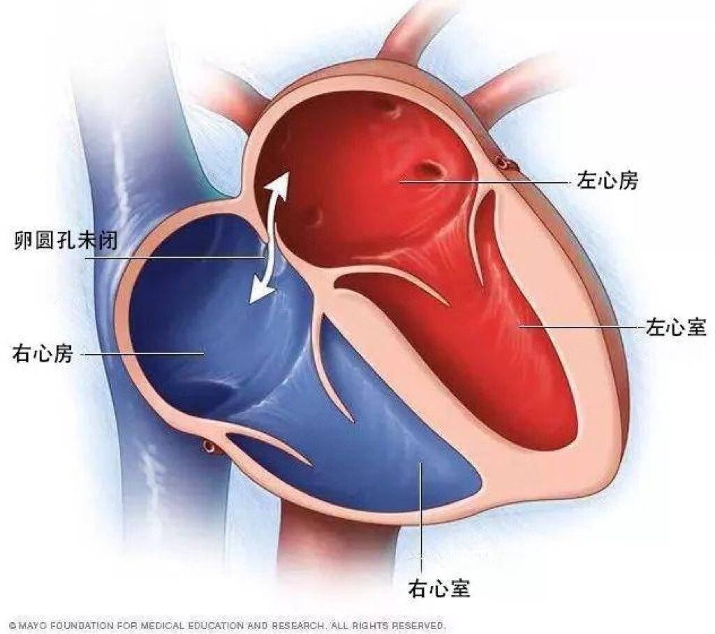 卵圆孔未闭示意图