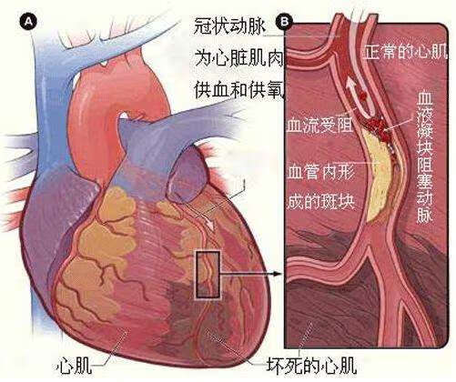 而心脏相当于是人体的发动机,如果心脏上多了一块疤痕,局部的心肌收缩