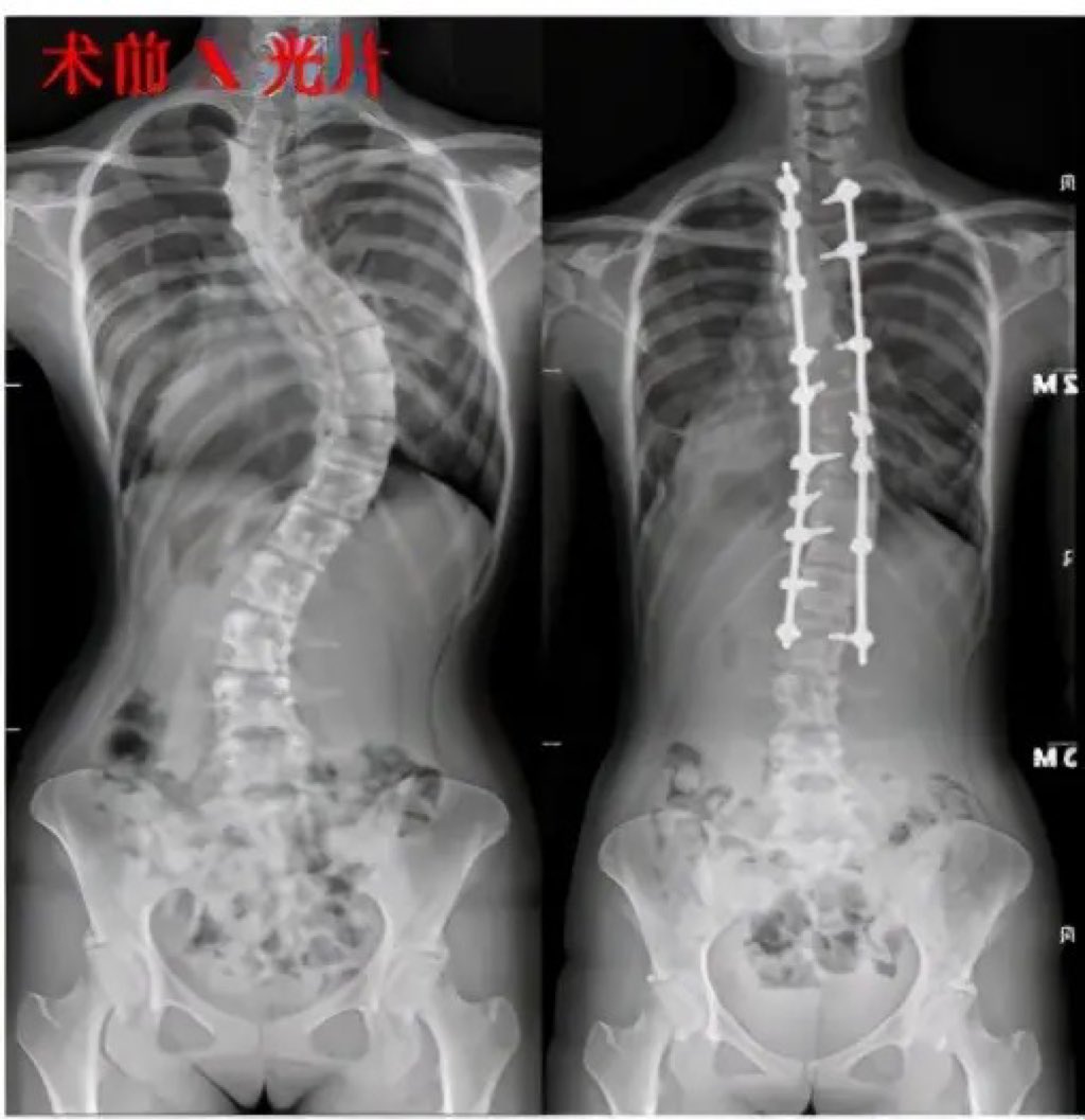 脊椎侧弯矫正，没有你想的那么难 - 术后康复专栏 - 杭州尤看运动健康管理有限公司
