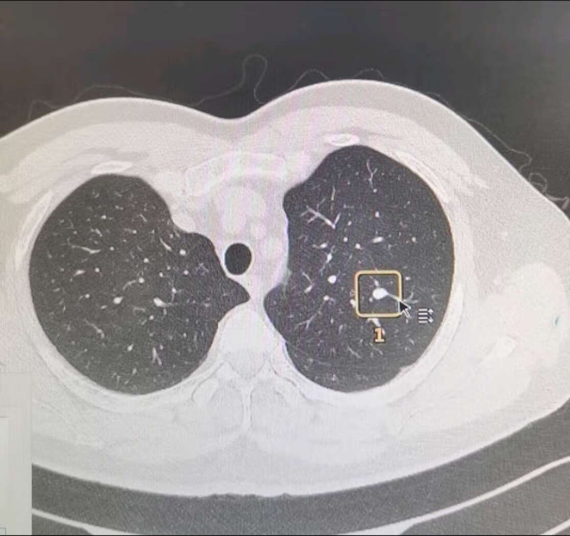 四十多岁有完全钙化肺结节很奇怪么?