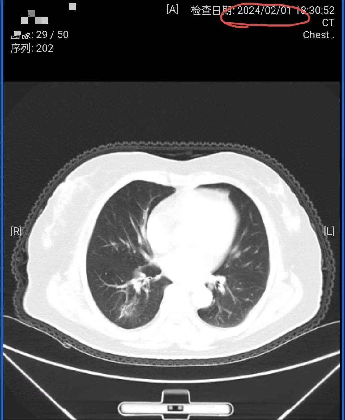 刘懿博士说肺癌（七二五〇）中医大夫怕耽误肺结节，十天拍三个CT-京东健康