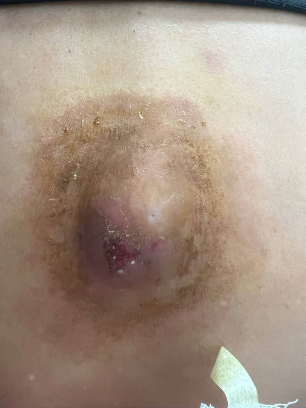 皮脂腺囊肿