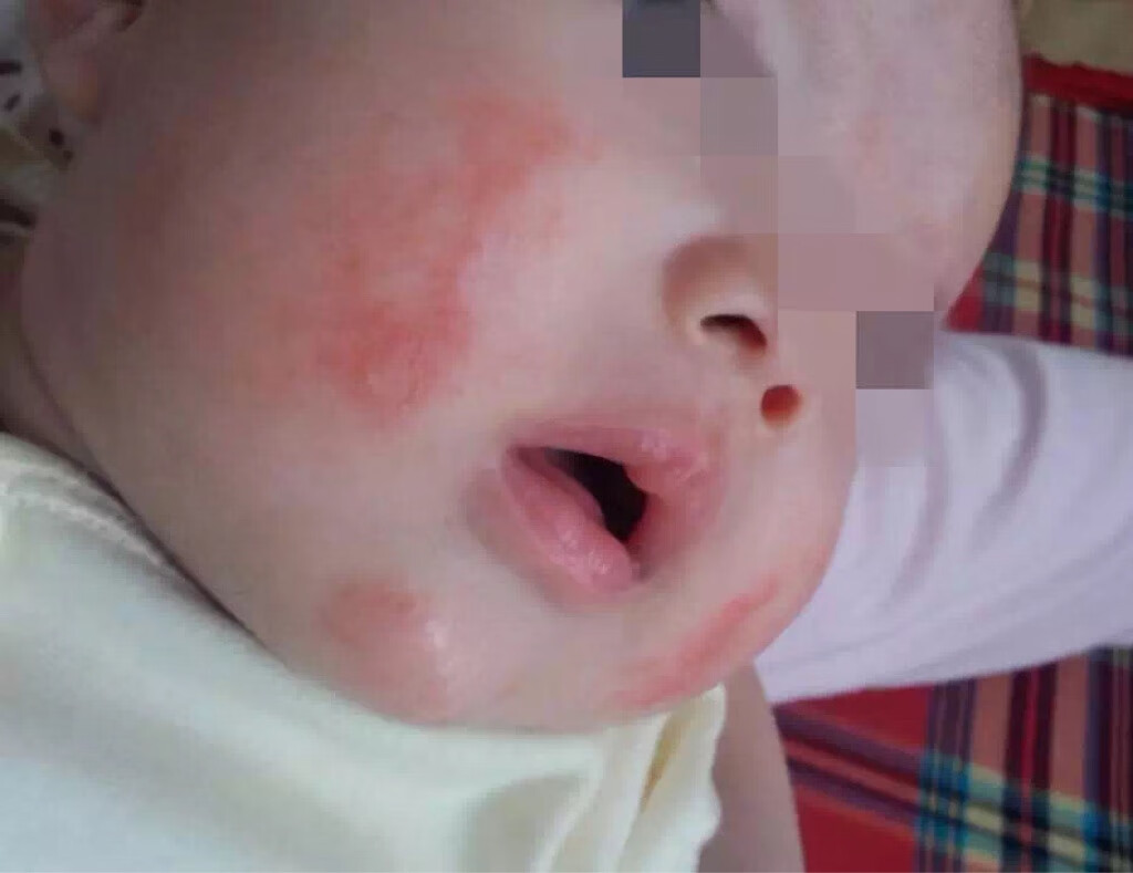 婴儿脸上红斑，出生到现在7个月大，该处红斑从出生到现在一直未消退 - 百度宝宝知道