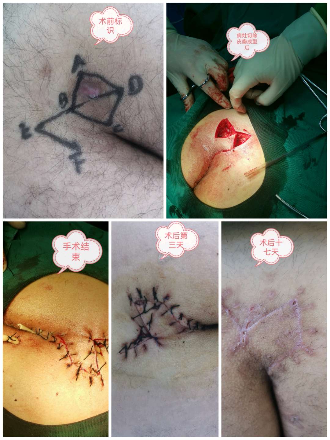 藏毛窦切除皮瓣转移成型术(limberg手术)