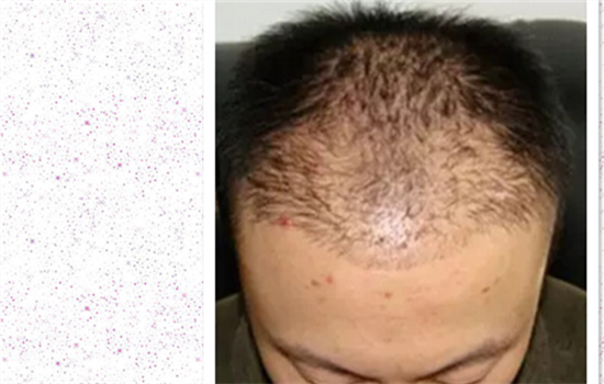 发际线植发失败案例 发际线植发失败了变成什