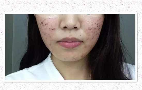 激光祛痘坑要多少次 只做一次激光祛痘坑皮肤