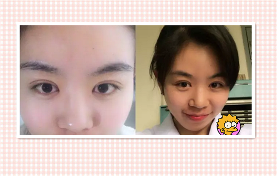 开眼角前后对比照片 开眼角眼睛真的会变大吗